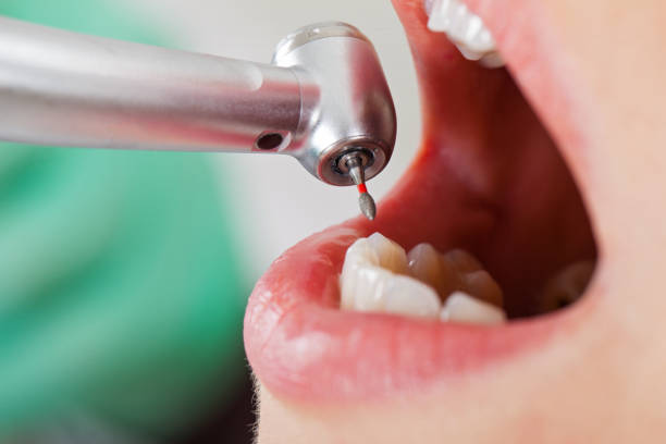 Best Emergency Treatment for Dental Infections or Abscesses in Bolivar, OH